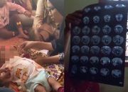 Perut Bayi Laki-Laki Berusia 5 Bulan Membesar, Dikira Kembung Ternyata ‘Hamil’ Kembarannya