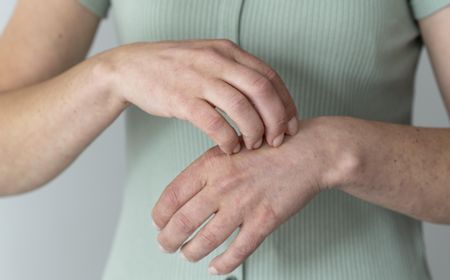 mengenal-psoriasis-vulgaris:-berikut-penjelasan,-gejala-serta-pencegahannya