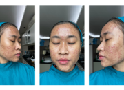 ‘Tak Keluar Rumah Dan Nangis Tiap Malam’ Cerita Acne Fighter Susah Payah Bangun Percaya Diri