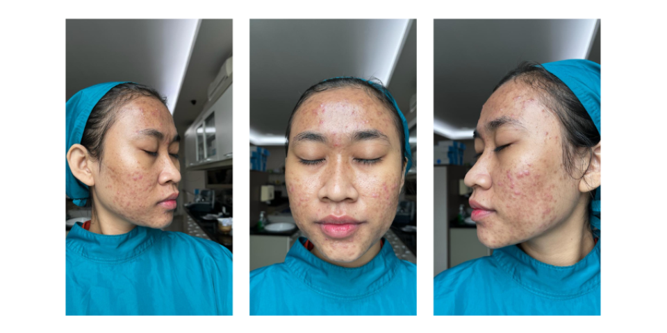 ‘tak-keluar-rumah-dan-nangis-tiap-malam’-cerita-acne-fighter-susah-payah-bangun-percaya-diri