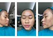 ‘Tak Keluar Rumah Dan Nangis Tiap Malam’ Cerita Acne Fighter Susah Payah Bangun Percaya Diri