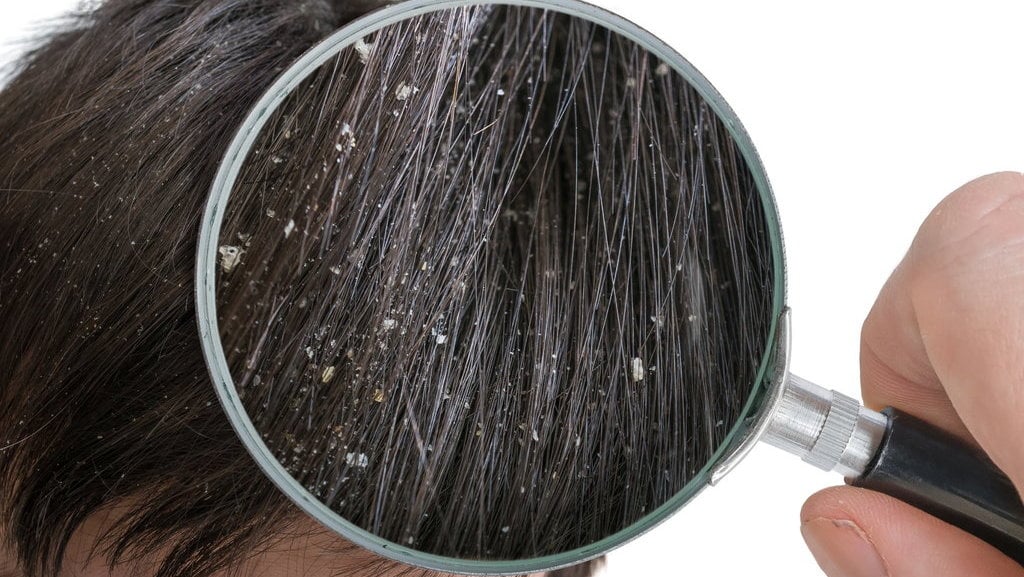 penyebab-ketombe-basah,-ciri-ciri,-dan-cara-mengatasinya